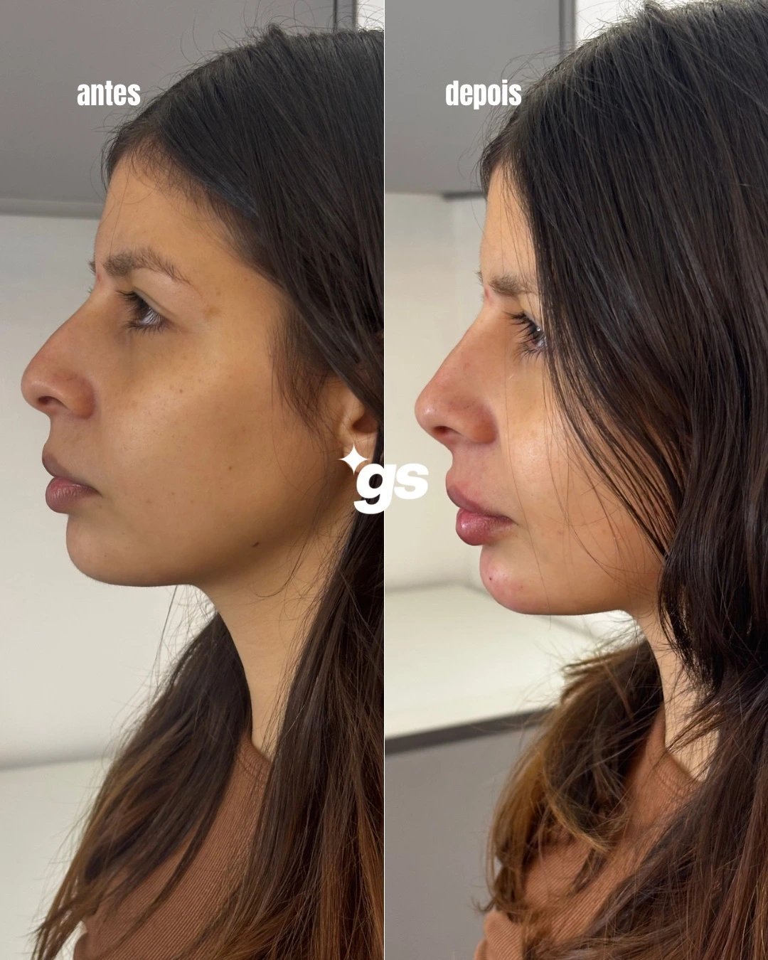 Comparação de resultado de harmonização facial, registro 1 fornecido pela Dra. Lilian