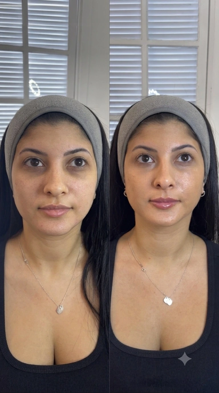 Comparação de resultado de harmonização facial, registro 3 fornecido pela Dra. Lilian