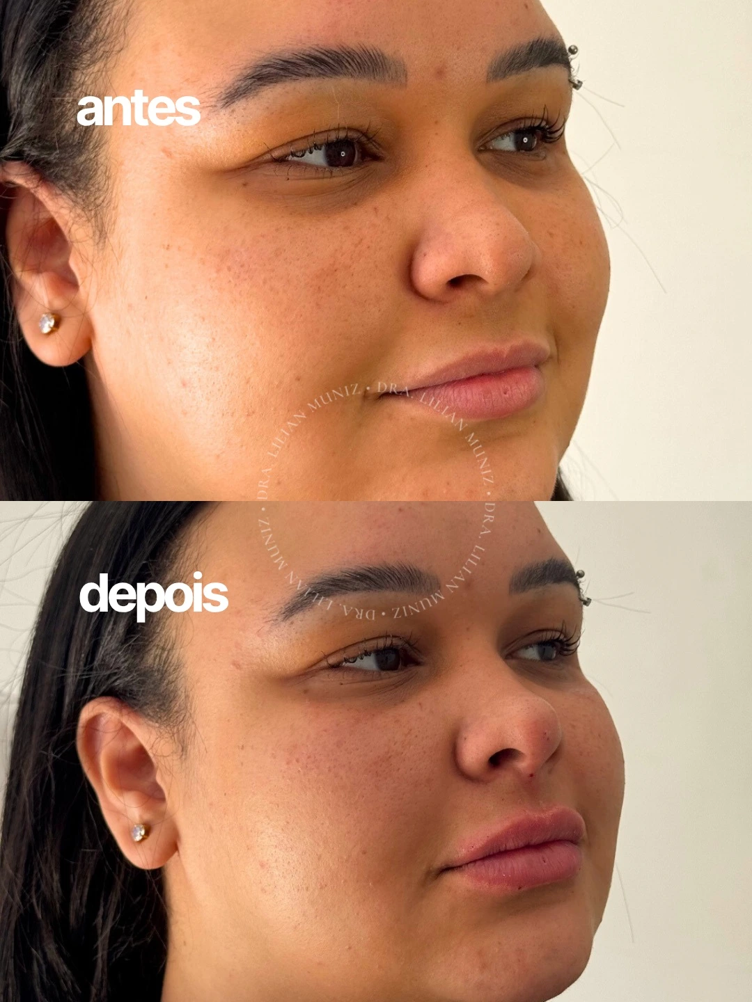 Comparação de antes e depois de preenchimento labial, caso 1 fornecido pela Dra. Lilian