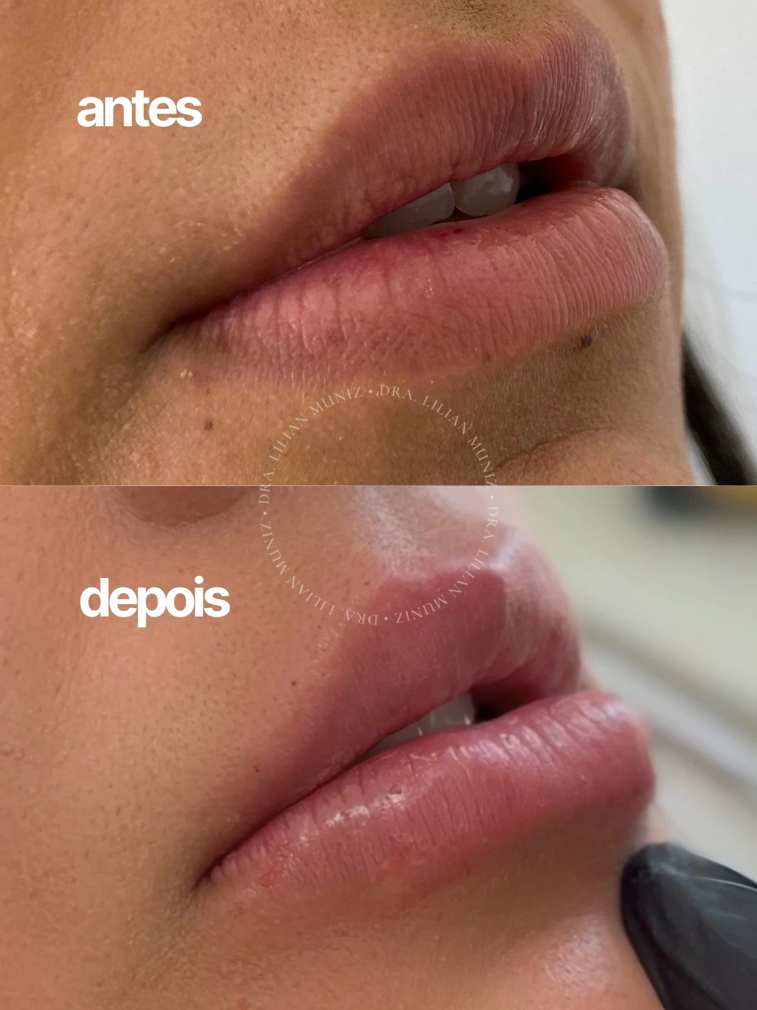 Comparação de antes e depois de preenchimento labial, caso 5 fornecido pela Dra. Lilian