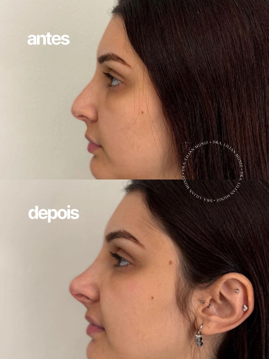 Registro comparativo de antes e depois de rinomodelação, caso 2, fornecido pela Dra. Lilian Muniz